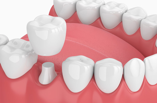 dental implants