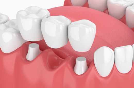 dental implants