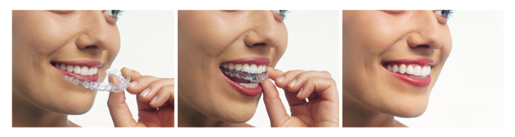 Trio of images of a woman inserting clear aligner trays used for Invisalign