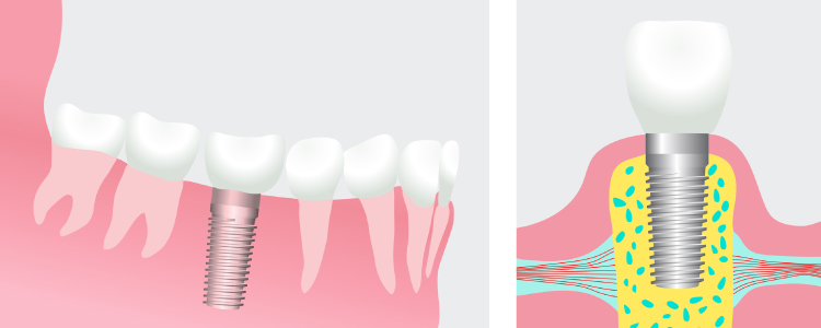 Artistic rendering of a dental implant showing the titanium post fused to the jawbone and topped with a restoration