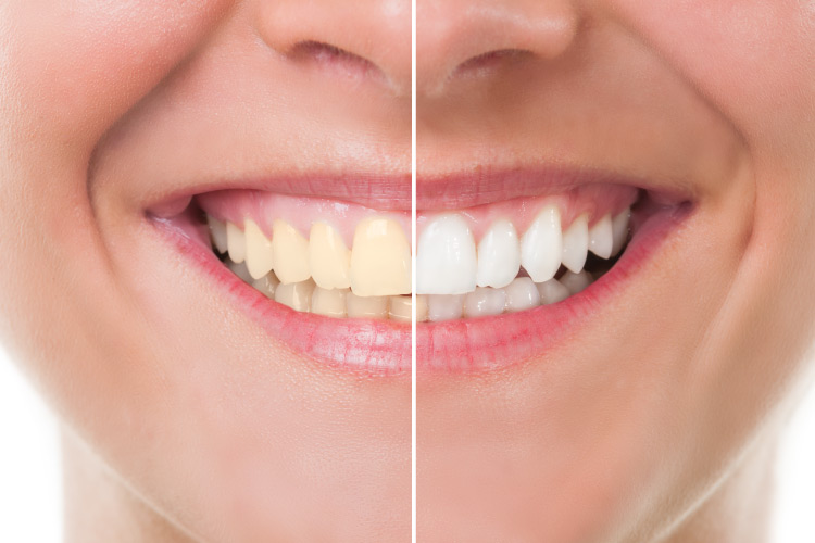 Teeth Whitening: Everything you need to know - Method Dental