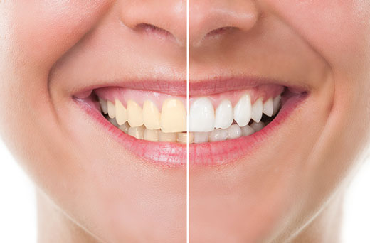 before and after whitening